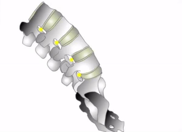SPONDYLOLISTHESIS.gif