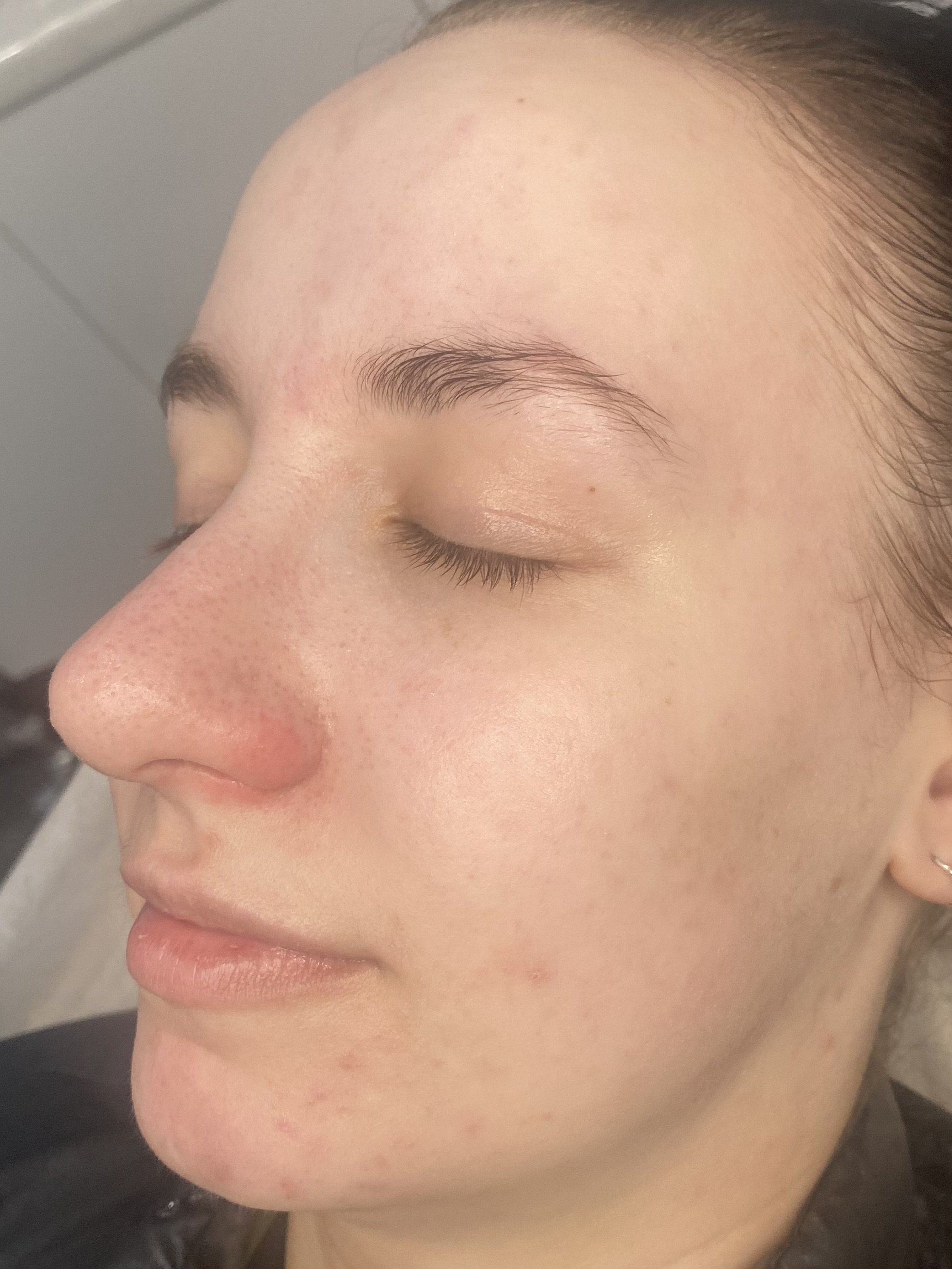 dermapen 4 results