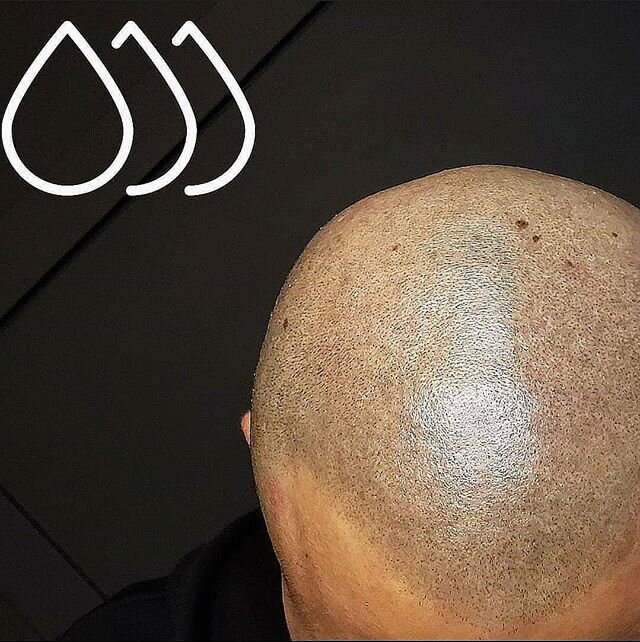 If you can tell it's SMP, then I'm not doing my job right. 🤯
.
#smp #cosmetictattoo #confidence #smptraining #beforeandafter #vancouverSMP #scalpmicropigmentation #theinkbarber #scalp #tattoo #vancouver #micropigmentation&nbsp; #headtattoo #guyswith