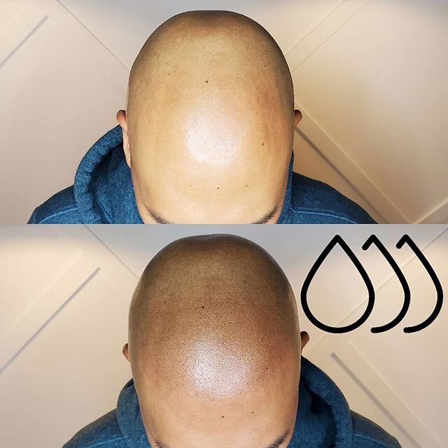 Transforming scalps, one tiny follicle impression at a time. 👌
.
#smp #cosmetictattoo #confidence #smptraining #beforeandafter #vancouverSMP #scalpmicropigmentation #theinkbarber #scalp #tattoo #vancouver #micropigmentation&nbsp; #headtattoo #guyswi