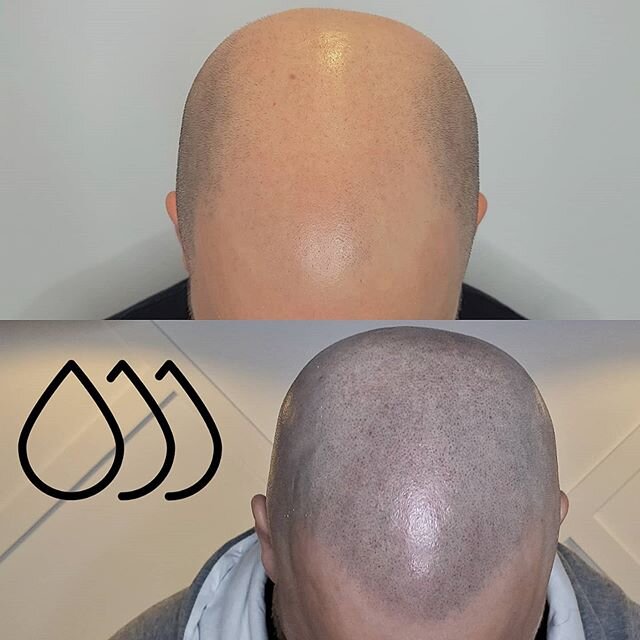 Scalp micropigmentation time machine. TOP: June 2017. BOTTOM: March 2020.
.
Book your phone consultation NOW.
Info@inkbarber.com