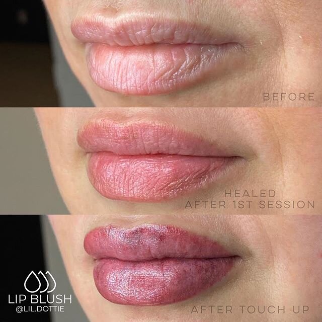 Lips! Lips! Lips!
&bull;
While bruising is normal, @inkling.smp aka my work wife, was kind enough to drink not one, but TWO cups of coffee right before her appointment which caused her to bruise and bleed a little more than normal 😑. This is why it 