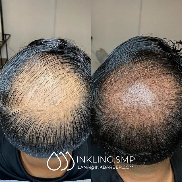 Shrinking the 🕳

A little mansity in progress to brighten your day. Each session reduces the balding at the crown and cutting the hair shorter with a higher fade in the back is the ideal length to blend it seamlessly. 
Showing 1 of 3 sessions.

If y