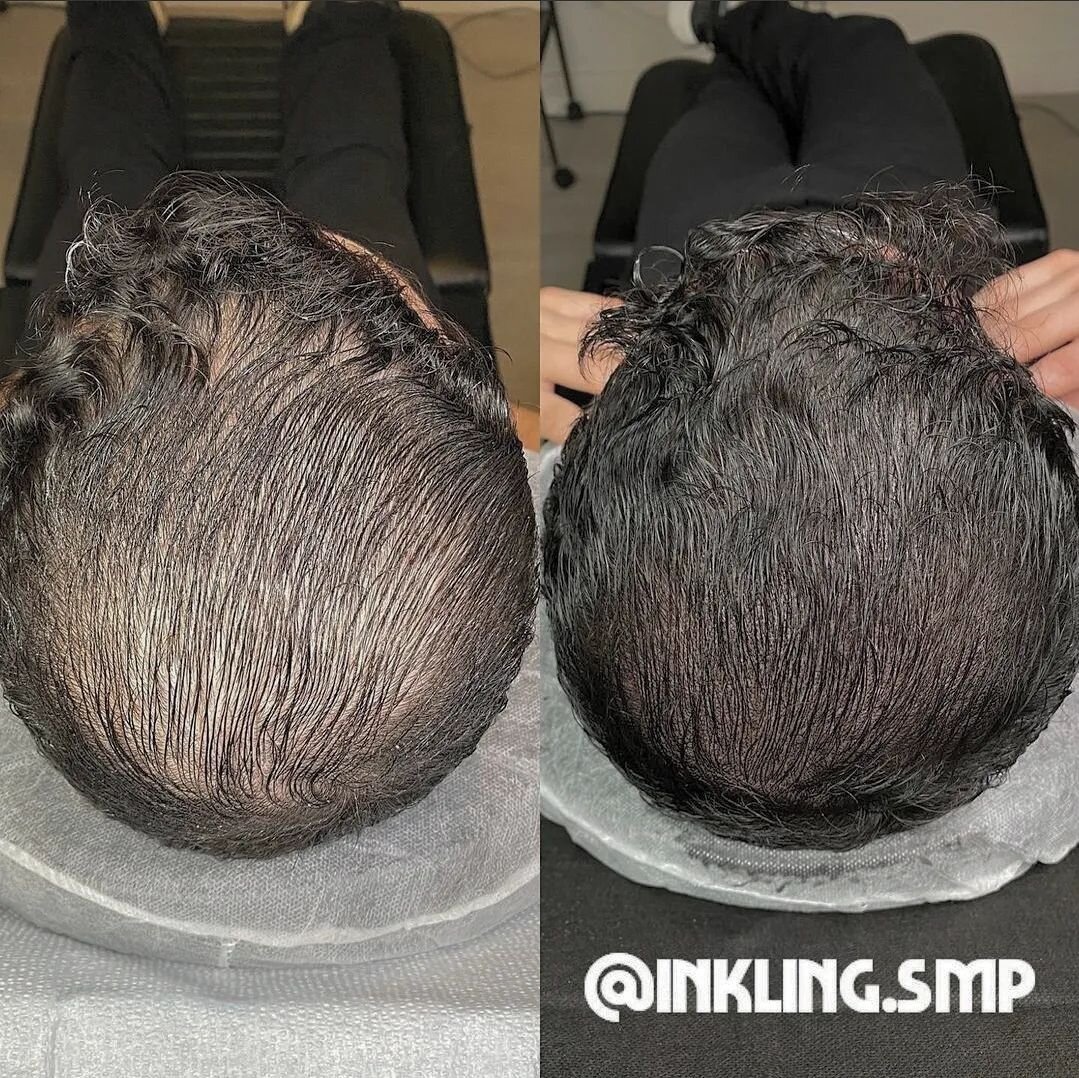 Freedom is not worrying about taking your hat off! Density fill perfection by @inkling.smp 
.
#scalpmicropigmentation #smp #hairtattoo #density #hairlosssolution #hairloss #thinhair #tattoo