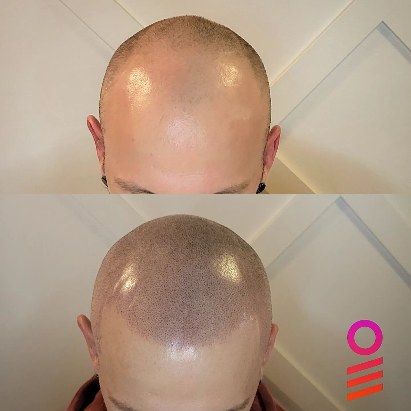 Start your 2023 off looking and feeling awesome! Book your consultation now at inkbarber.com! 📱 Transformation by @theinkbarber 
.
#smptraining #smp #scalpmicropigmentation #transformation #beforeandafter #hair #tattoo #barber