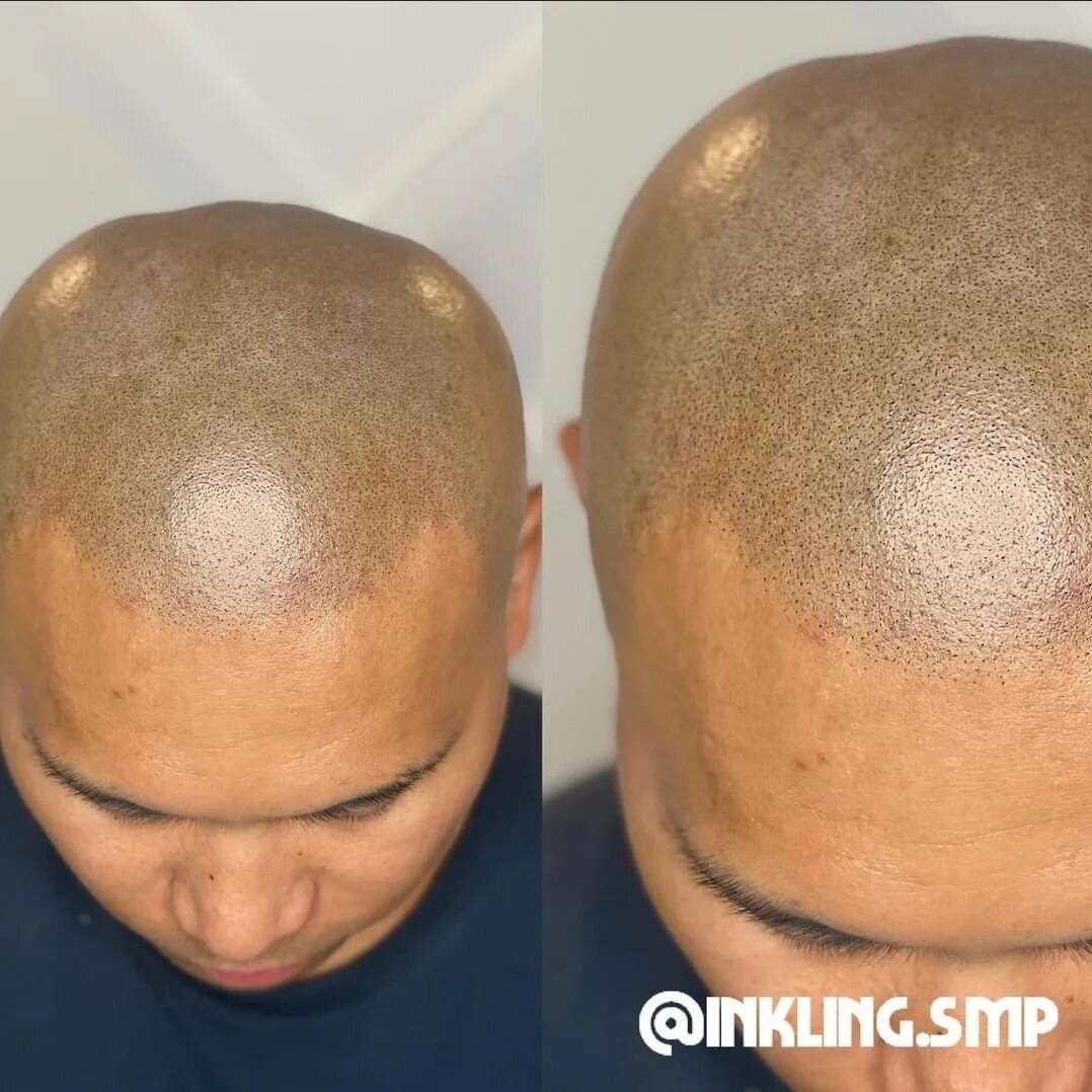 The ultimate compliment is when people can't believe it's SMP. If we can't tell from extremely close range then believe us: No one else will. 👊 Flawless work as always by @inkling.smp. 🙌⚡
.
#scalpmicropigmentation #smp #cosmetictattoo #hairtattoo #