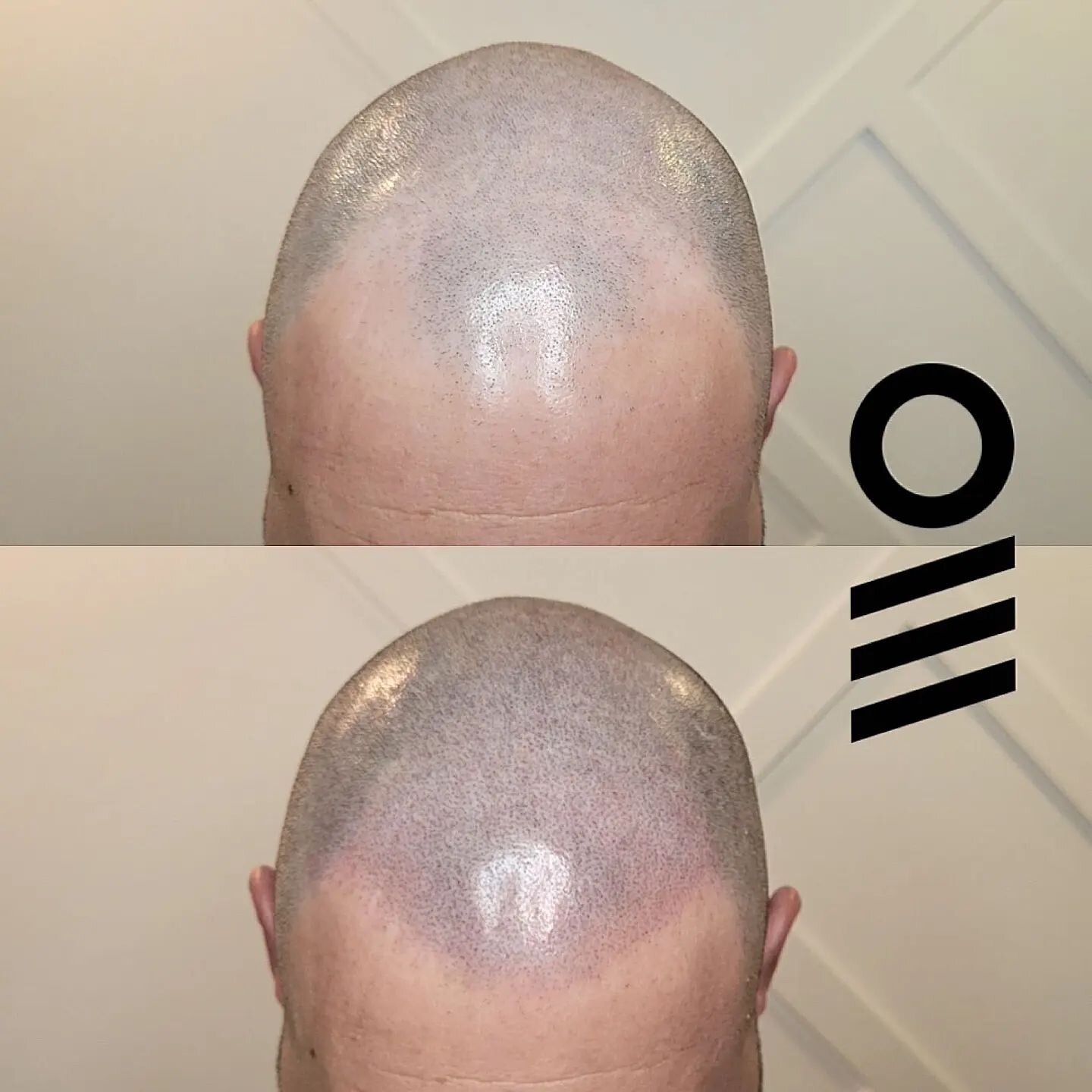 Round 1?! Yeah that's right. 2 to go 🤯 It's a crazy week here at @ink.barber as we enter the holiday season! ❄️
.
#scalpmicropigmentation #ink #tattoo #headtattoo #inkbarber #micropigmentation #hair #barber #beforeandafter #smp #smptraining