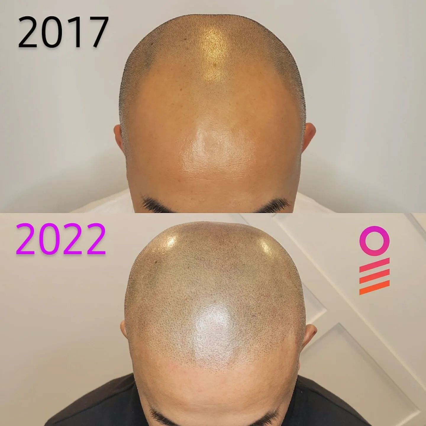 2017-2022. 5 year refresher. Turning back the clock again. 🔥 SMP by @theinkbarber 
.
#scalpmicropigmentation #smp #refresher #tattoo #scalp #hairtattoo #natural