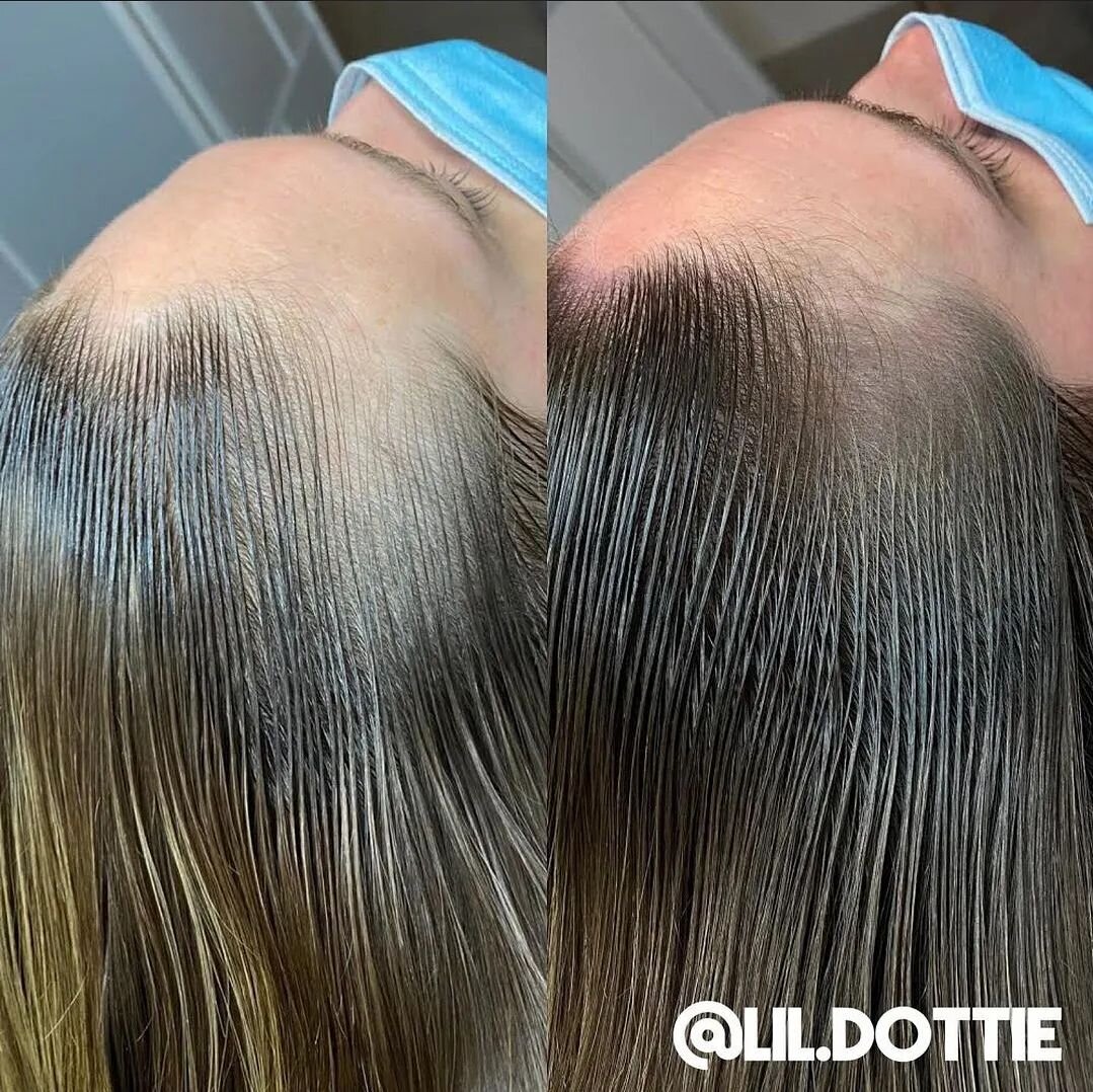 It's an early Christmas MIRACLE!! @lil.dottie sleighing it with this female density transformation!! 🔥
.
#inkbarber #scalpmicropigmentation #smp #tattoo #cosmetictattoo #hairloss #transformation #beforeandafter #beauty