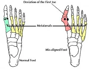 bunion doctor podiatrist florida clearwater tampa st petersburgh
