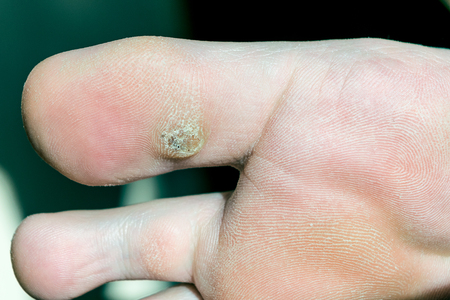 Wart treatment feet