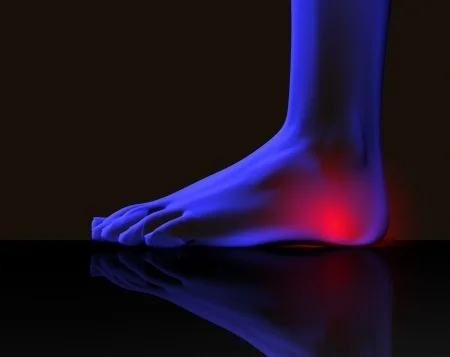 Treating Tarsal Tunnel Syndrome