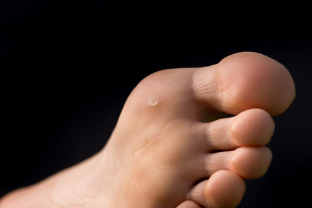 warts on foot bottom