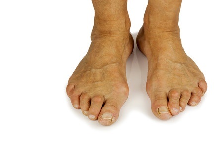The 3 Best Treatments for Bunions — Fit Feet For Life