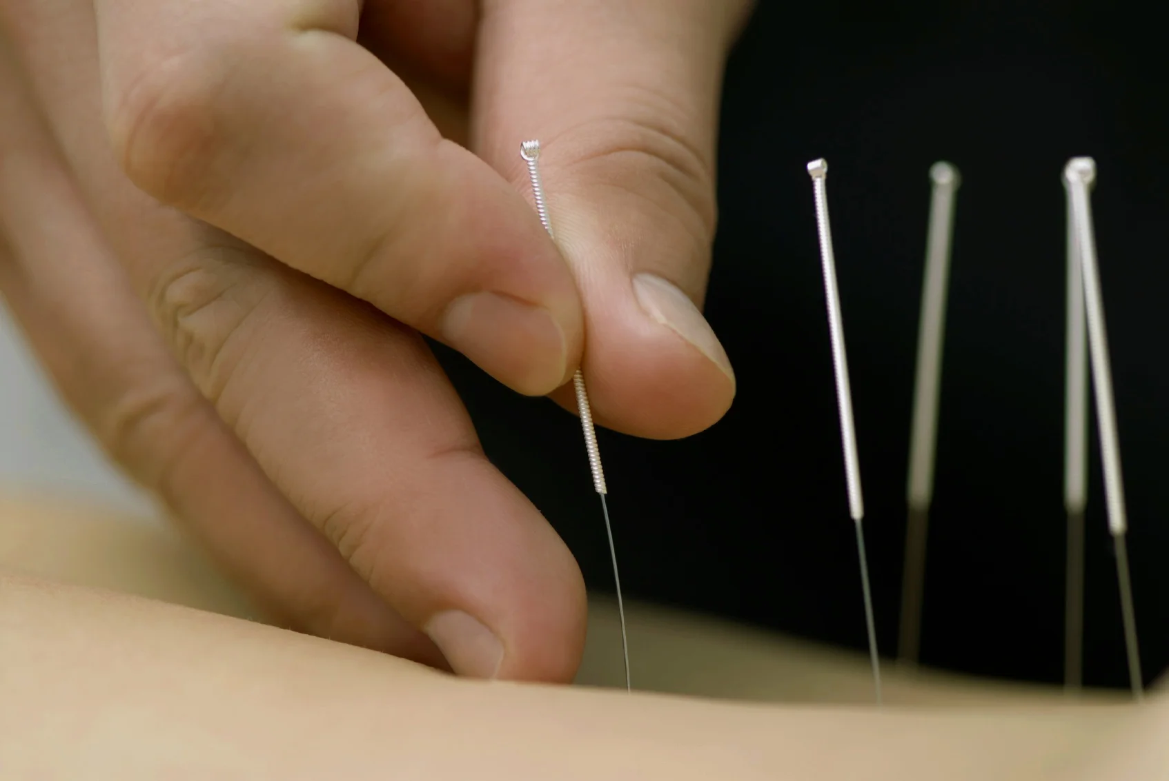 Acupuncture.jpg