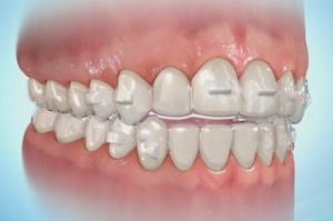 Invisalign