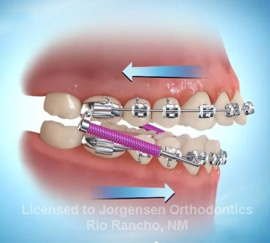 Overbites, Orthodontics