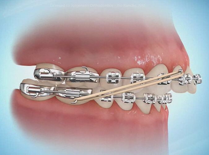 What Are Orthodontic Elastics Rubber Bands And How Do They Work Affordable Braces Jorgensen Orthodontics