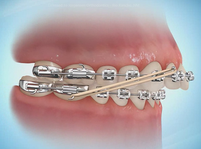 How important is wearing rubber bands with braces?