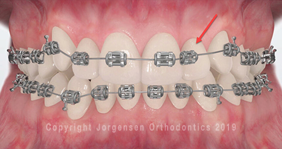Orthodontic Emergencies: What to Know and What to Do
