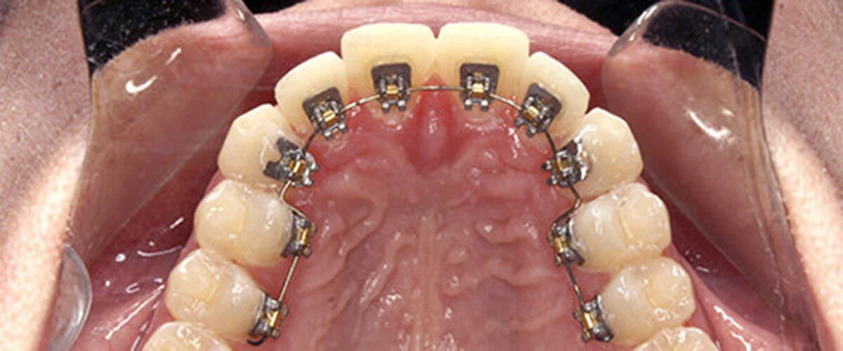 invisible braces