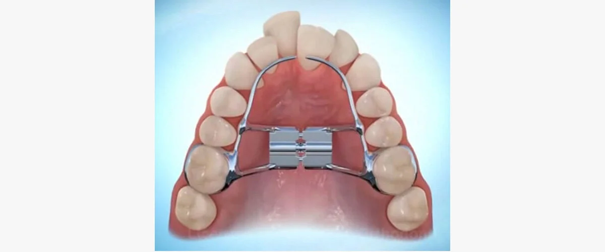 What to Expect With Your Child's Orthodontic Expander | Jorgensen ...