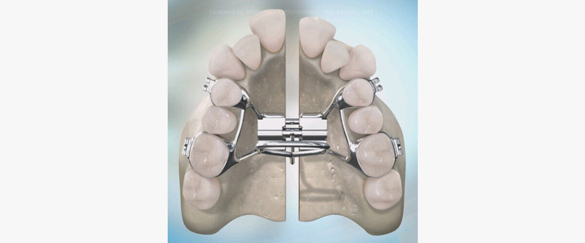 What Is a Surgically Assisted Rapid Palatal Expander?
