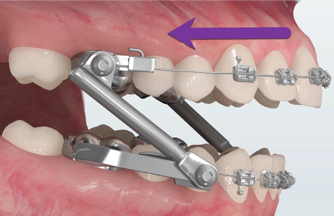 Does Orthodontic Treatment Cause Sleep Apnea?