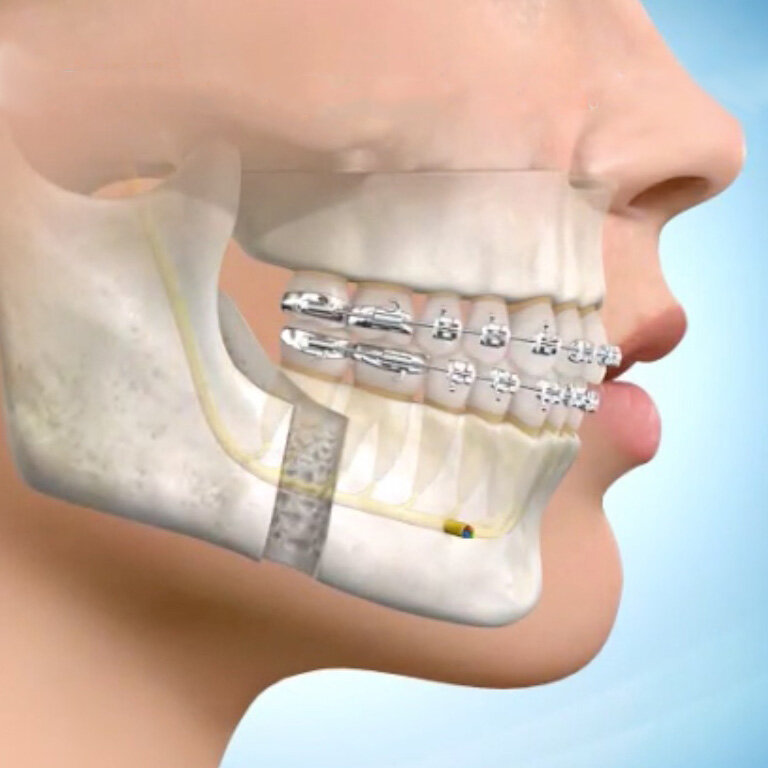 Can Orthodontic Treatment Cure Sleep Apnea?