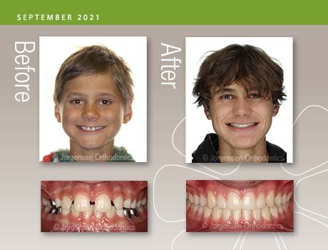 How Orthodontic Braces Work - Kyger Orthodontics BlogKyger Orthodontics Blog