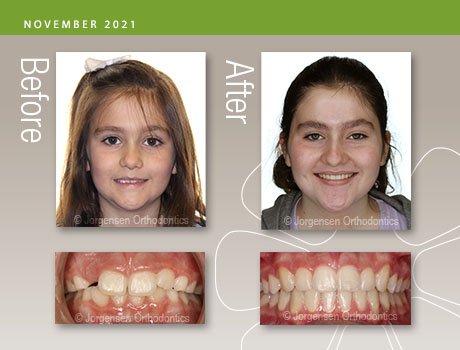 How Orthodontic Braces Work - Kyger Orthodontics BlogKyger Orthodontics Blog