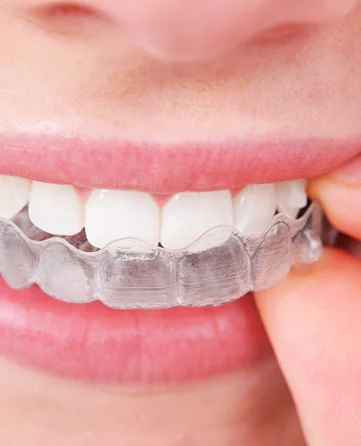 img-invisalign.jpg