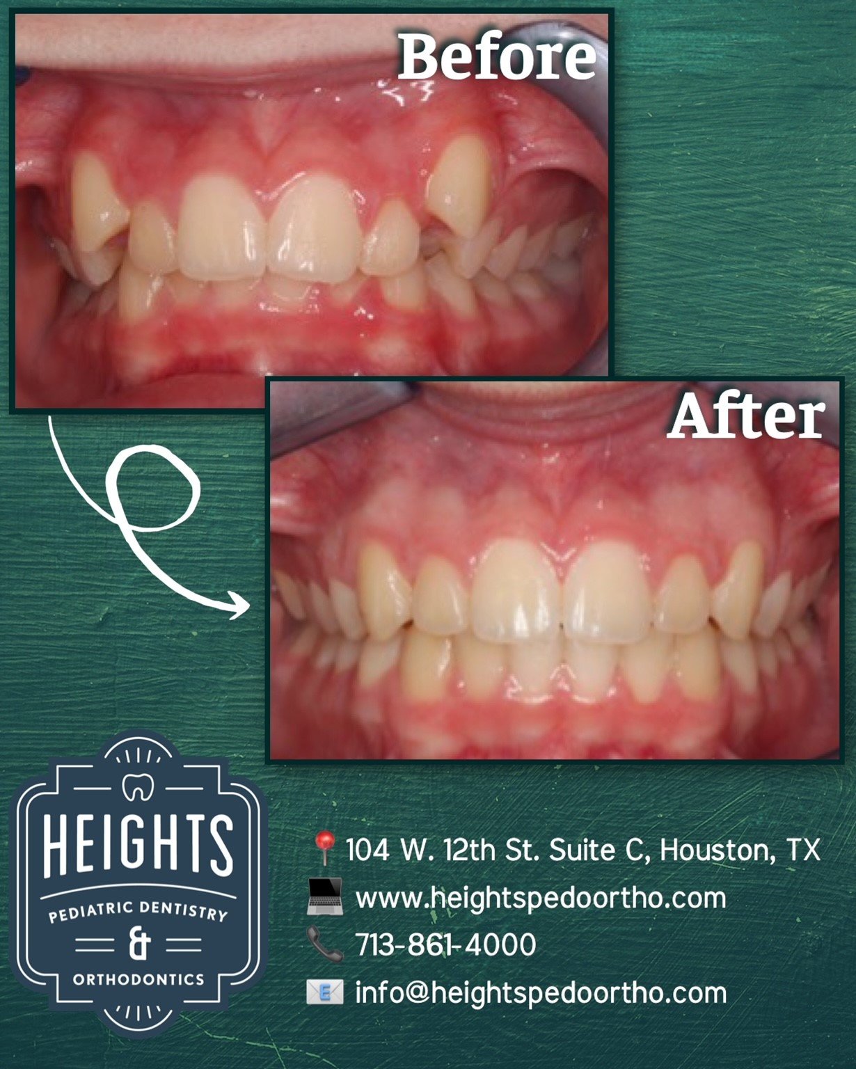 ✨BEFORE and AFTER ✨
This patient of ours presented with crowding and high displaced canines. With upper and lower braces, and a palatal expander, we accomplished this beautiful straight smile!

#heightspedoortho #braces #weloveourpatients #heightshou