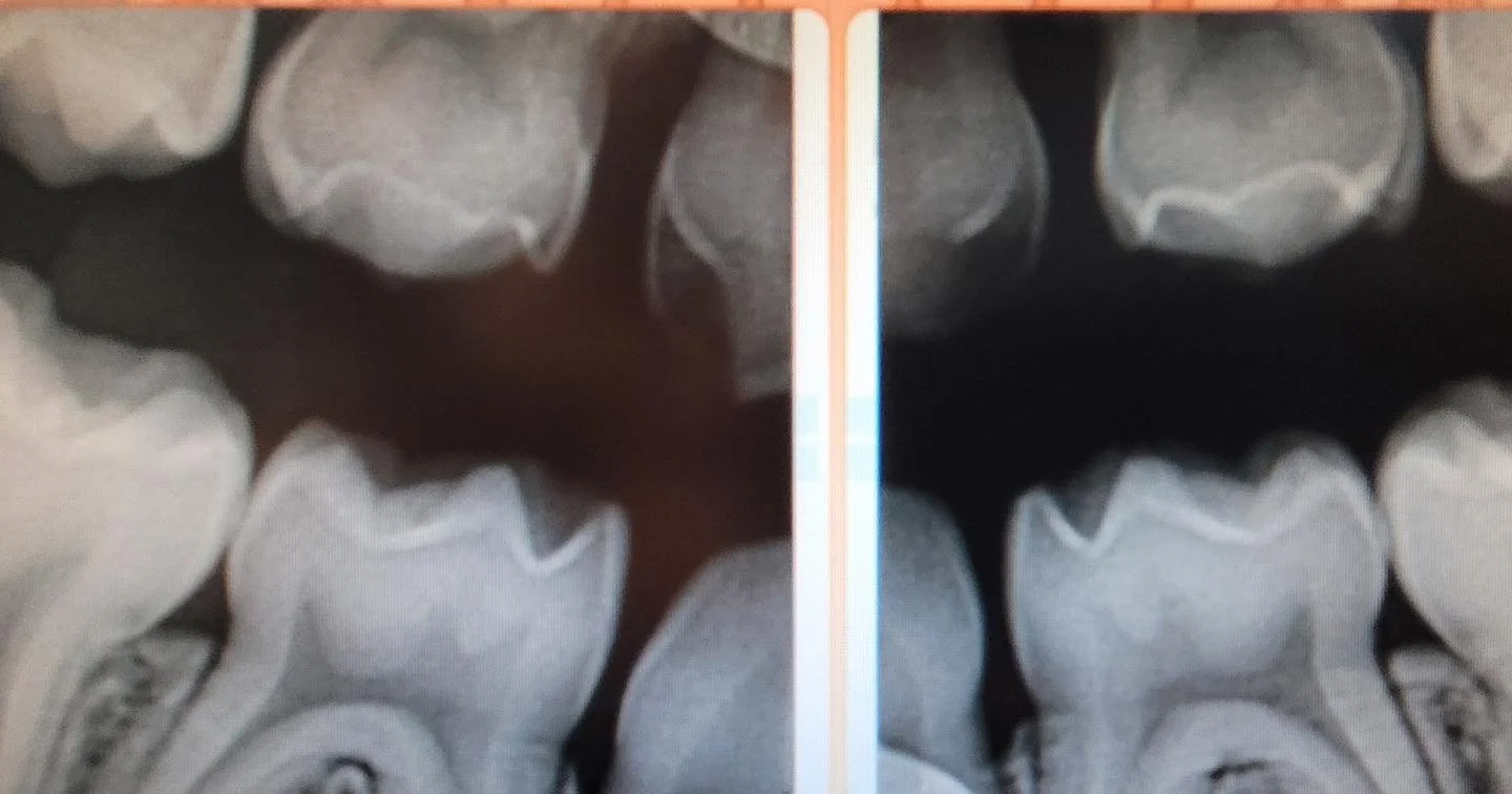What are "bitewing" xrays and why do we take them? — Heights Pediatric Dentistry & Orthodontics