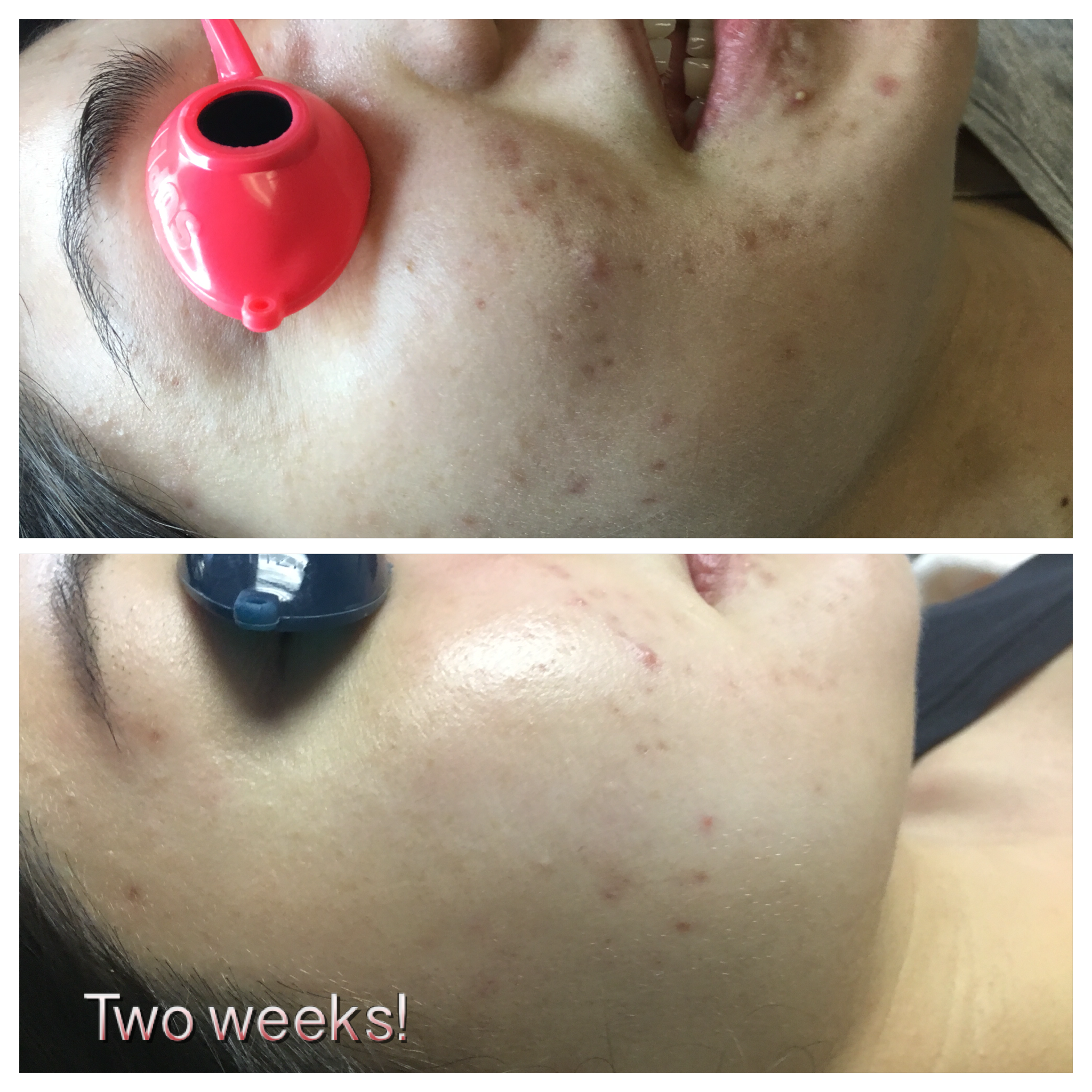 Clearer skin with the right facial products!