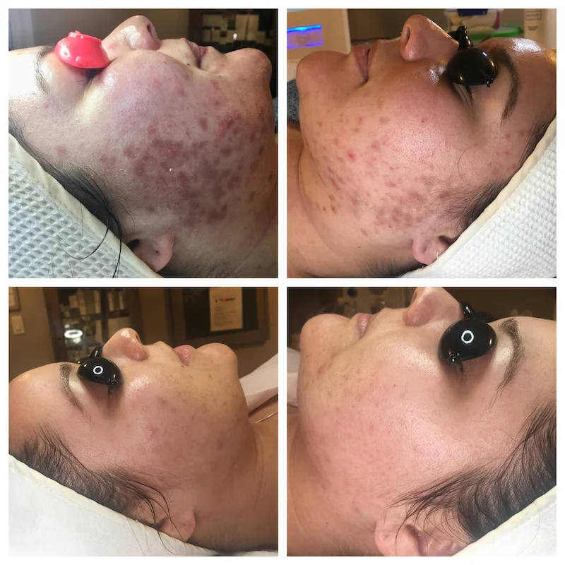 Client that came in after being treated by the Derm with products that were too much for her skin. Her skin was so sensitive and the acne had not Improved. The redness (acne post inflammatory hyperpigmentation) took about six months to fade away. Her skin is no longer sensitive.