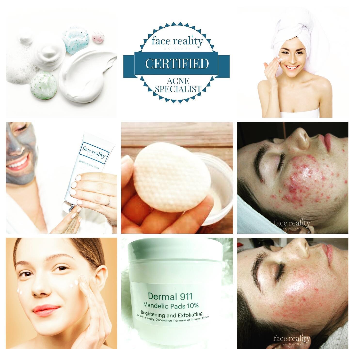It takes a variety of things to tackle acne.