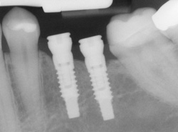 Copeland Family Dental provides implant care. 