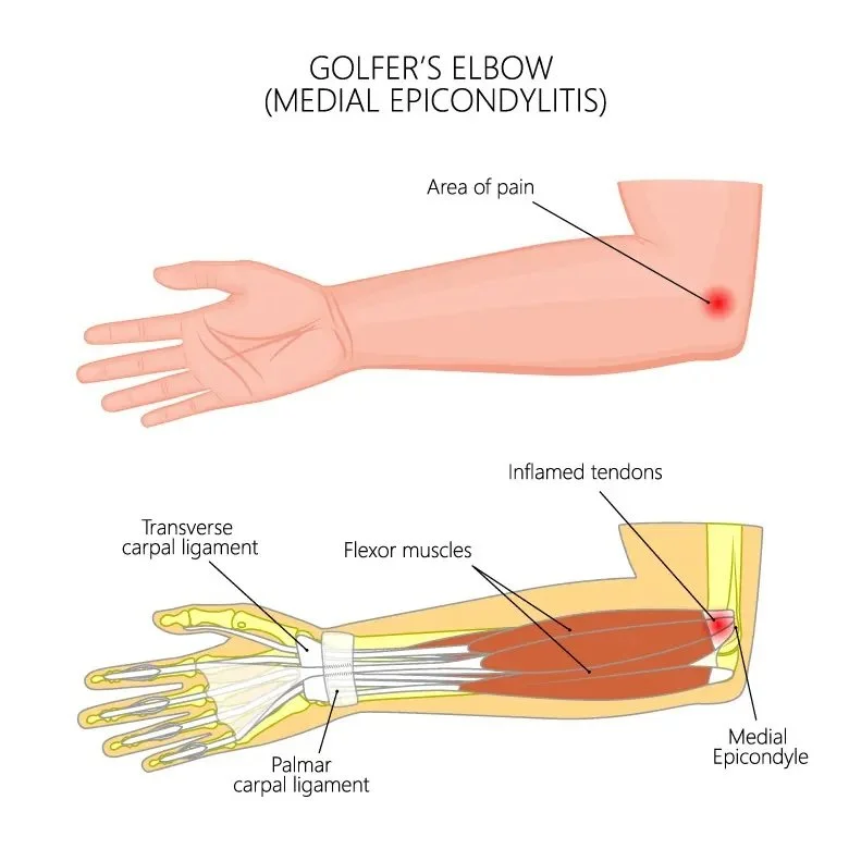 Golfer’s Elbow (Medial Epicondylitis)