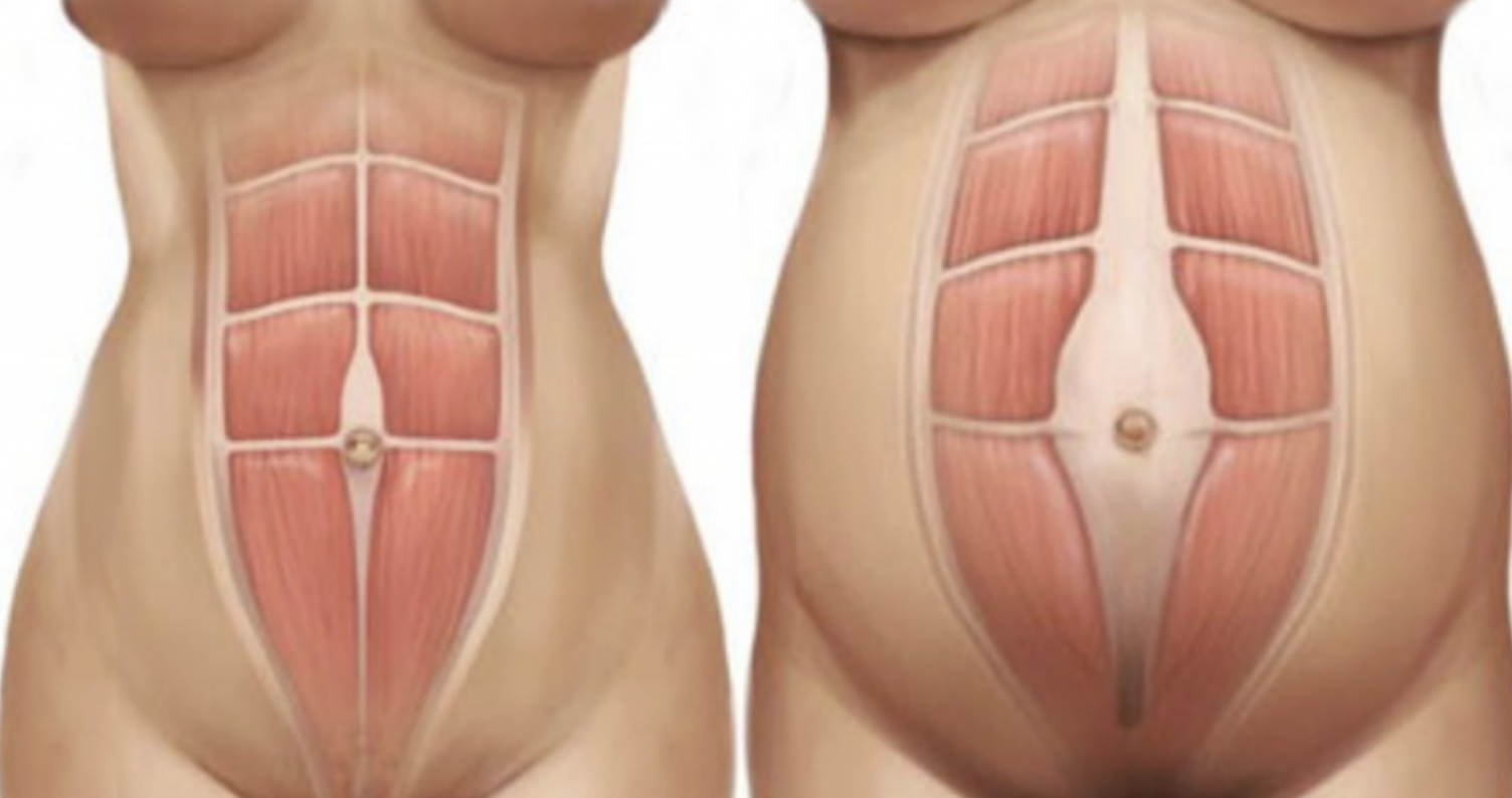Diastasis Recti: What’s Actually Going On With Your Core?