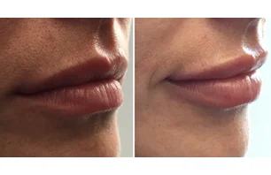 Dermal Filler (Lips)