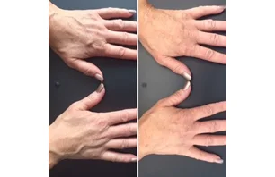 Dermal Filler (Hand Rejuvenation)