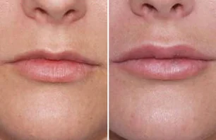 Dermal Filler (Lips)