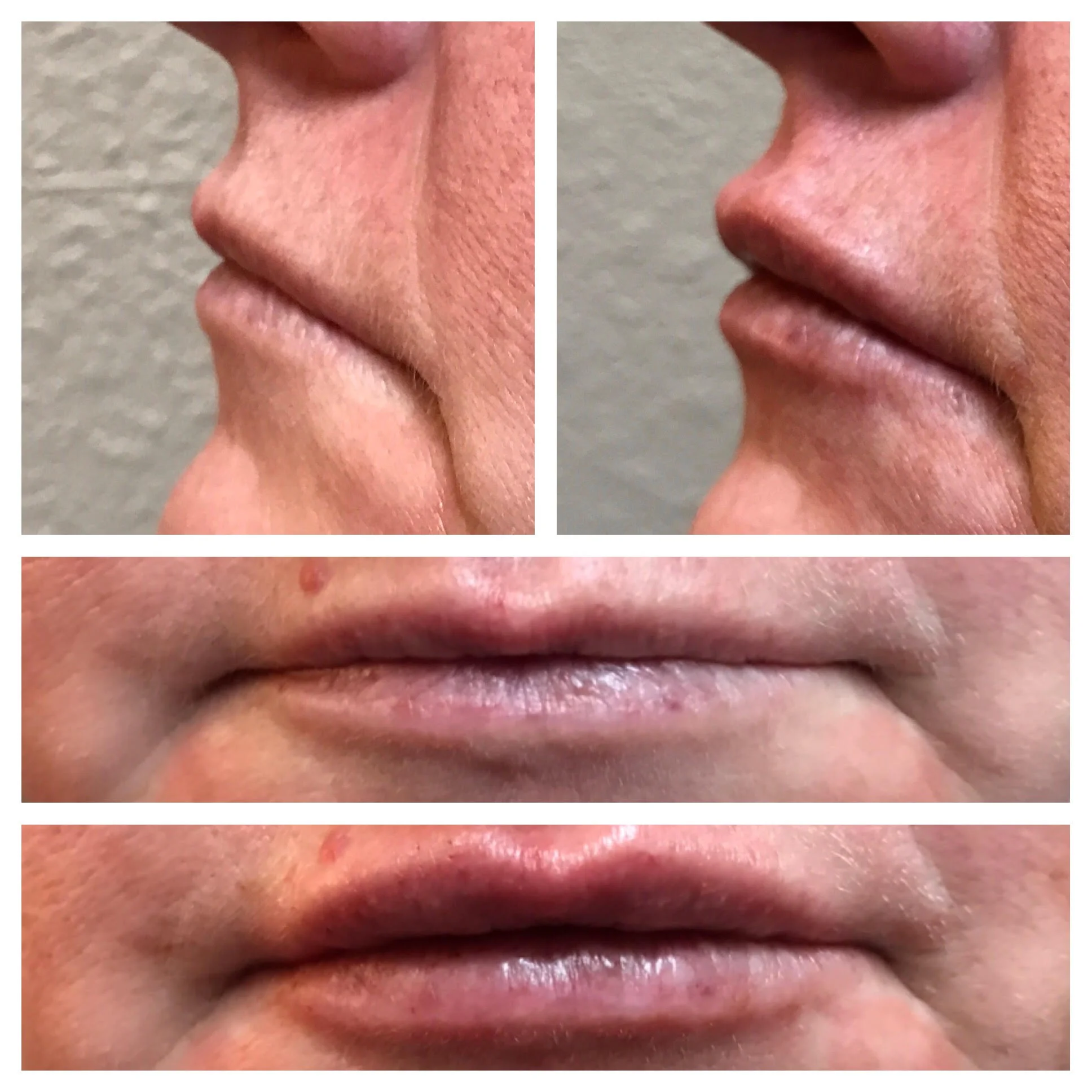 Dermal Filler (Lips)