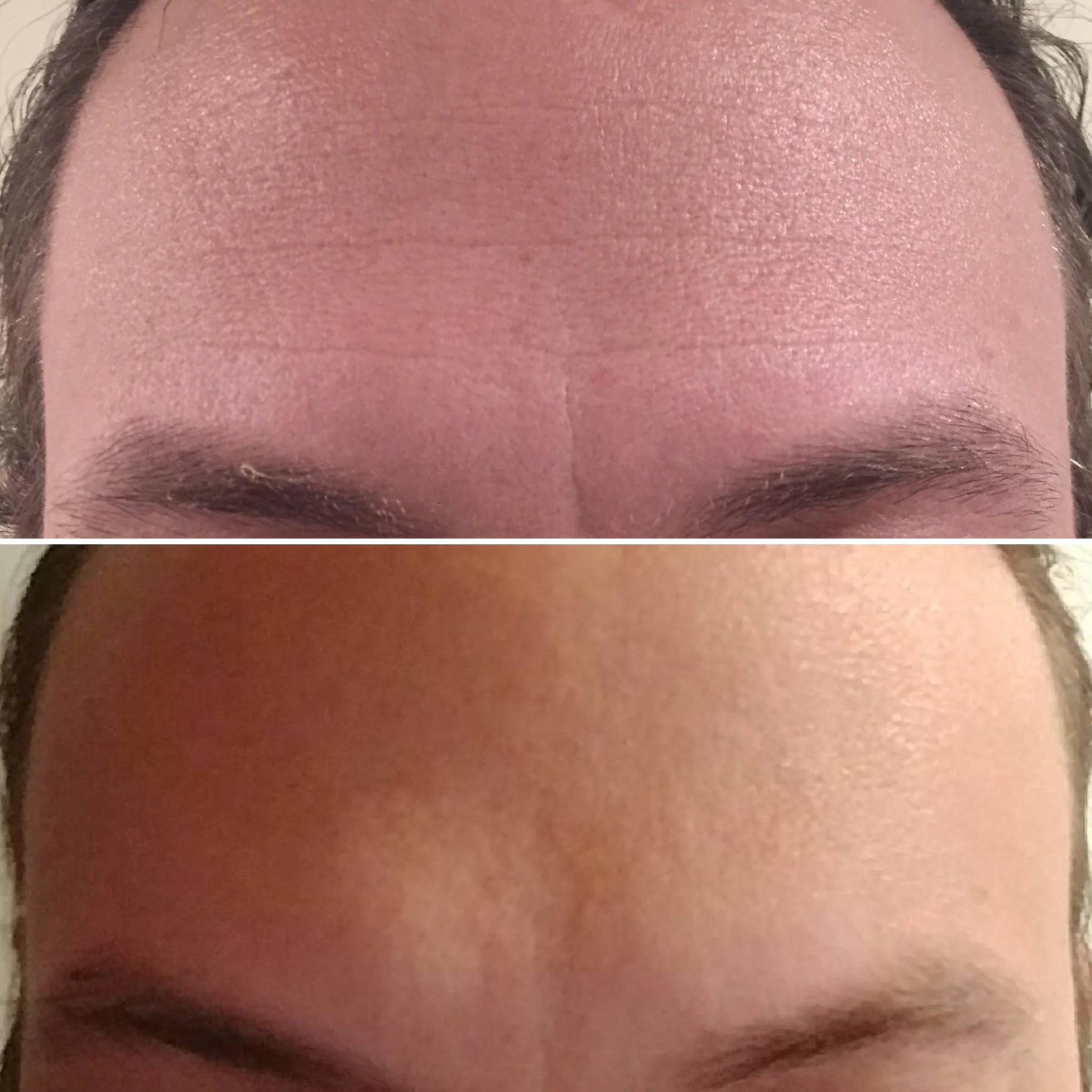 Botox (Forehead & Brow)