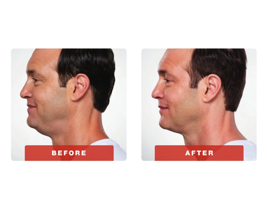 Kybella