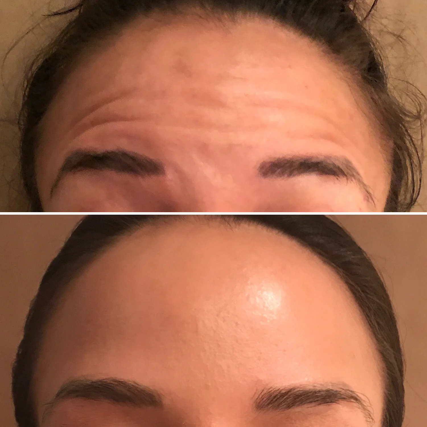 Botox