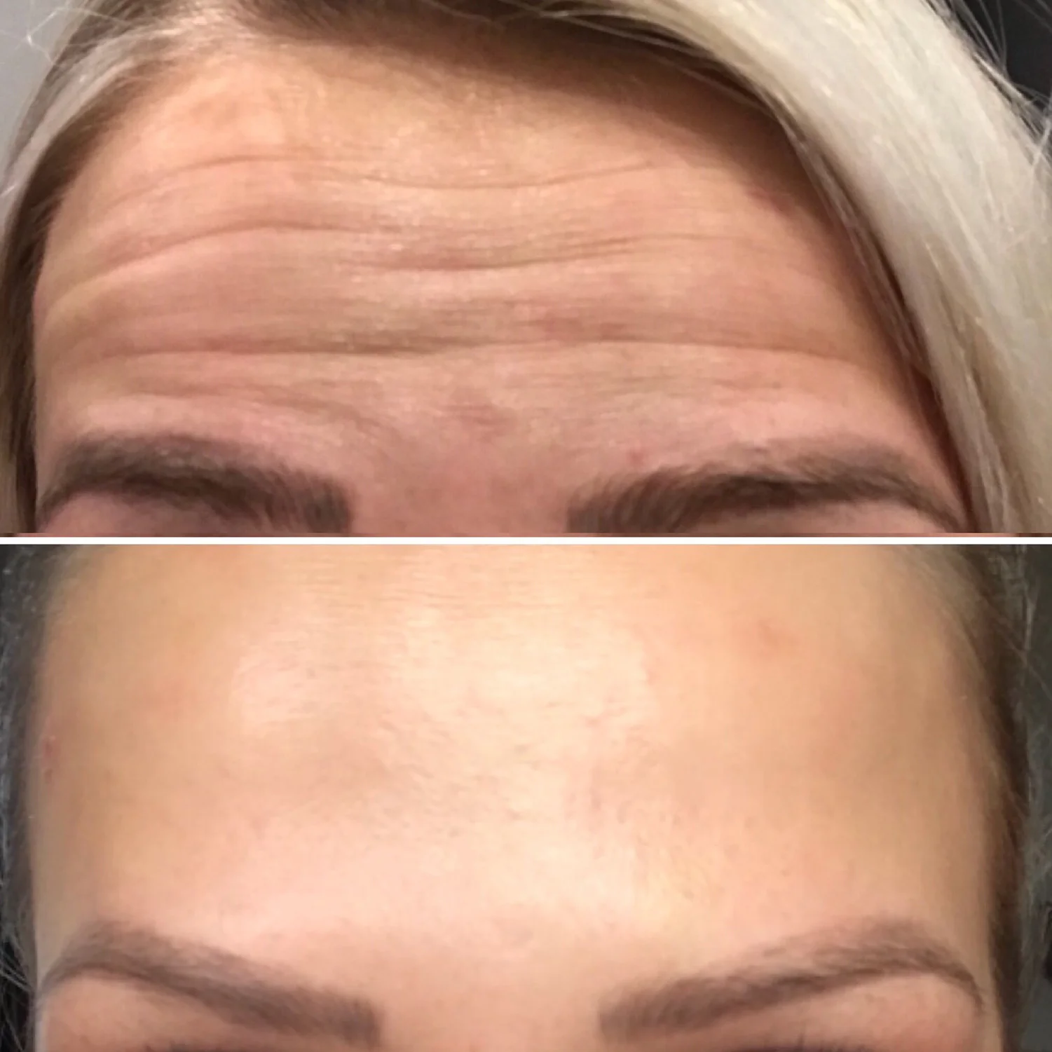 Botox