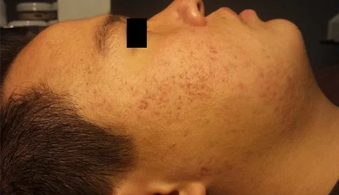 8 weeks using Celluma 2x a week