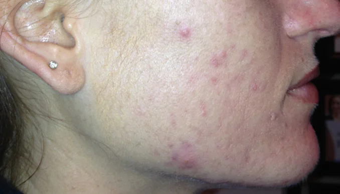 8 weeks using Celluma 2x a week